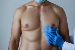 Understanding the Causes and Treatment of Puffy Nipples in Men